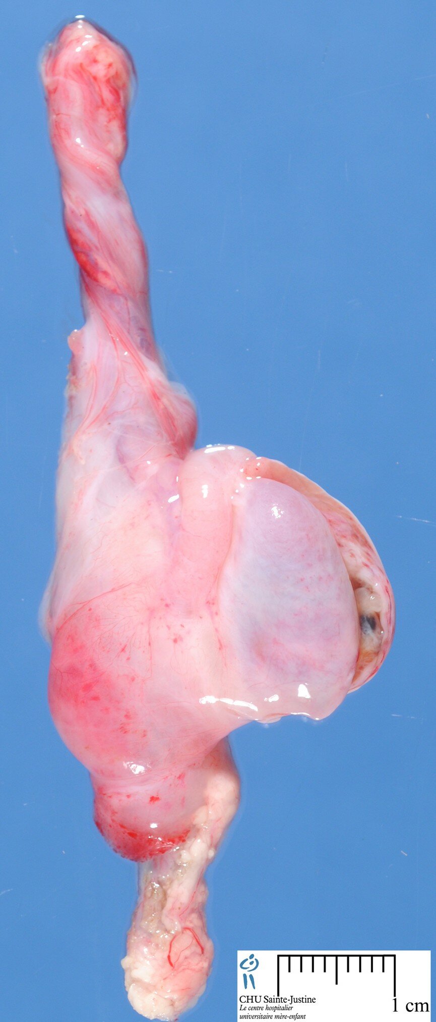 Diffuse Malignant Mesothelioma